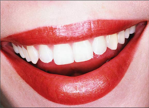 blanqueamiento dental