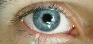 mesoterapia facial blefaroplastia ocular